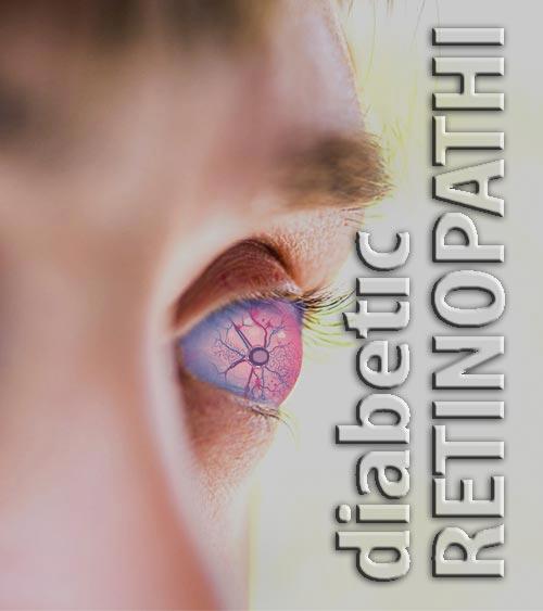 diabetic-retinopathi-cover-image